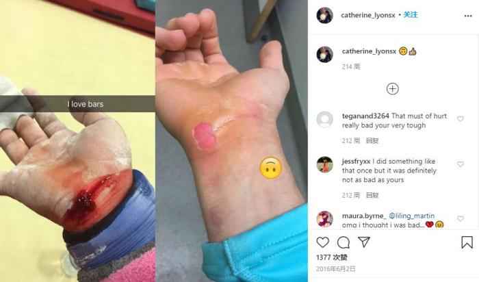 几年前,莱昂斯的个人社交媒体上曾晒出练习中手被磨破流血的照片。 这群光鲜的英国体操姑娘背后,有个灰色的童年